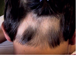 alopecia-areata