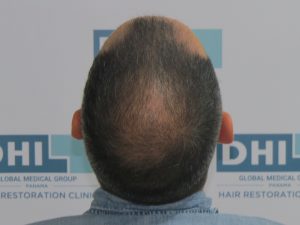 Resultado de Transplante de Cabello - Norwood 4