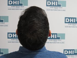 Resultado de Transplante de Cabello - Norwood 4