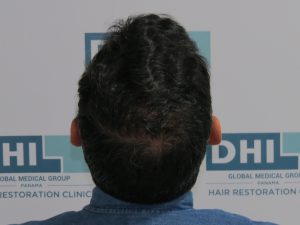 Resultado de Transplante de Cabello - Norwood 4