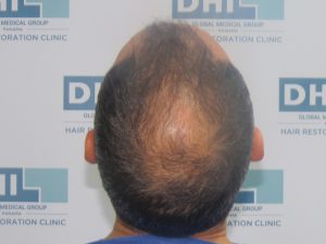 Resultado de Transplante de Cabello - Norwood 4