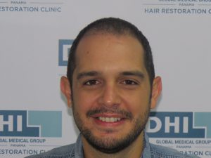 Resultado de Transplante de Cabello - Norwood 4