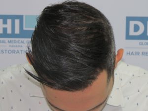 Resultado de Transplante de Cabello - Norwood 4