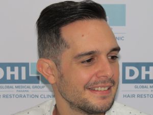 Resultado de Transplante de Cabello - Norwood 4