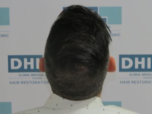 Resultado de Transplante de Cabello - Norwood 4