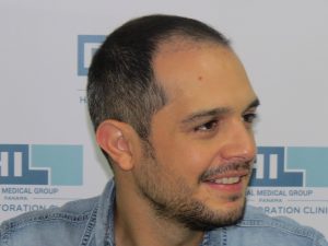 Resultado de Transplante de Cabello - Norwood 4