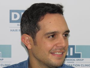 Resultado de Transplante de Cabello - Norwood 4