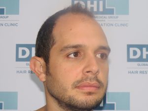 Resultado de Transplante de Cabello - Norwood 4