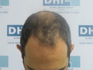 Resultado de Transplante de Cabello - Norwood 4