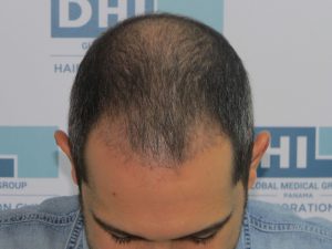 Resultado de Transplante de Cabello - Norwood 4