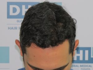 Resultado de Transplante de Cabello - Norwood 4