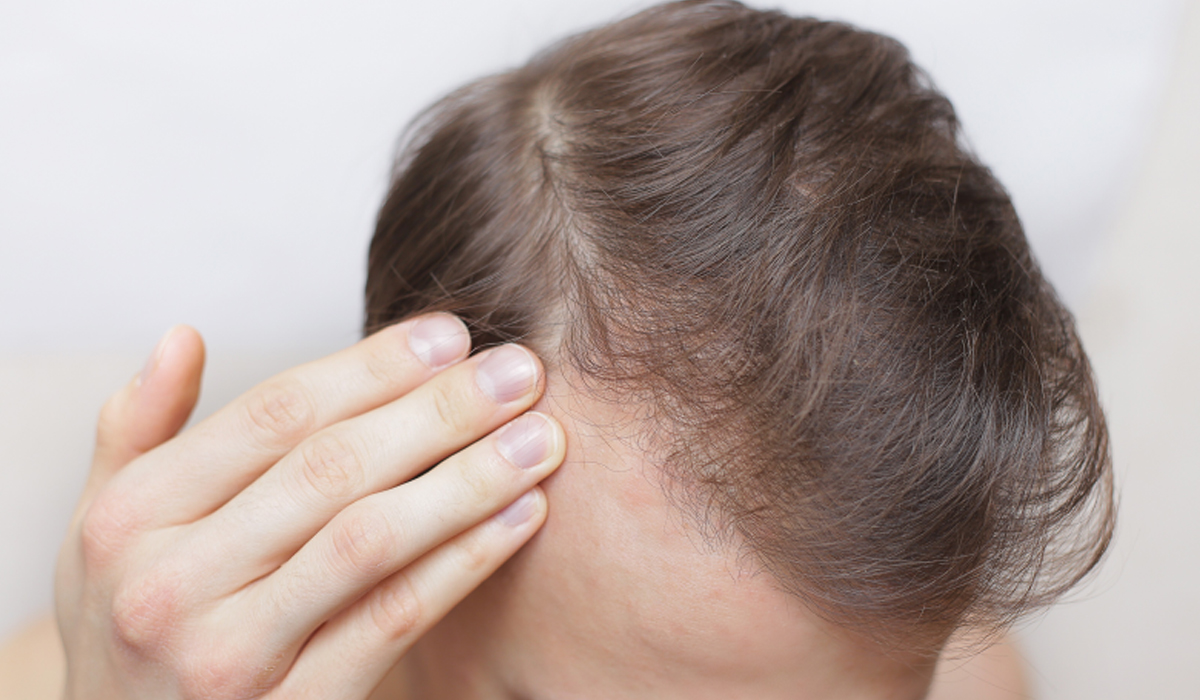 Es normal la picazón después del trasplante de cabello