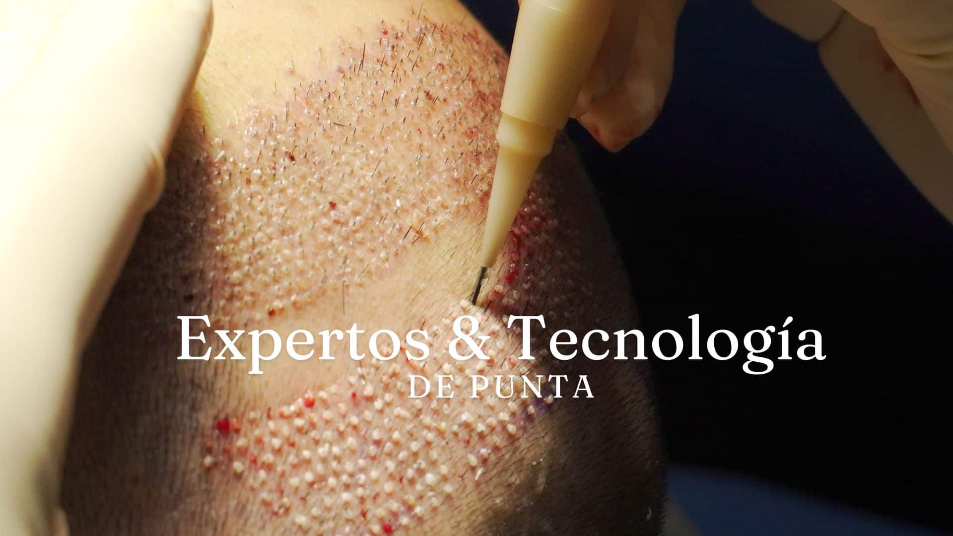 Trasplante de Cabello en Panamá: Expertos y Tecnología de Punta